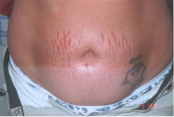 Stretch Marks - Before